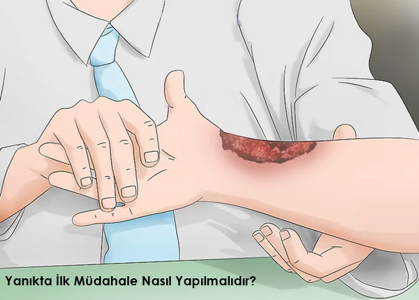 Yanık Seti Nedir, Ne İşe Yarar?